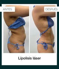 Lipólisis láser - Dr. Jeisson Gutiérrez Cañas