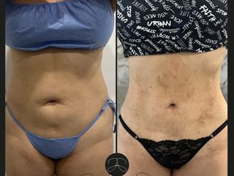 Lipólisis láser antes y después - 860007