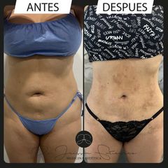 Lipólisis láser - Dr. Jeisson Gutiérrez Cañas