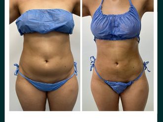 Lipólisis láser antes y después - 860008