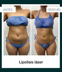 Lipólisis láser - Dr. Jeisson Gutiérrez Cañas