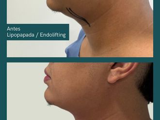 Cirugía de papada antes y después - 877148