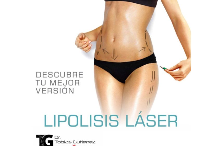 Lipólisis láser antes y después - 639800