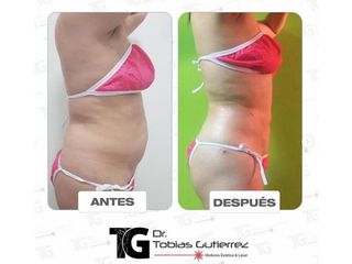 Lipoescultura