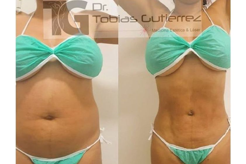 Lipólisis láser antes y después - 642761