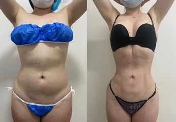 Liposucción - Dr. Tobias Gutiérrez