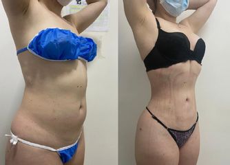 Liposucción - Dr. Tobias Gutiérrez