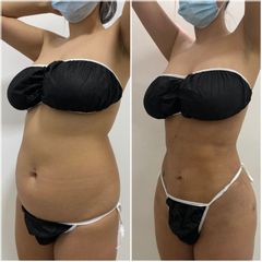 Lipoescultura - Dr. Tobias Gutiérrez