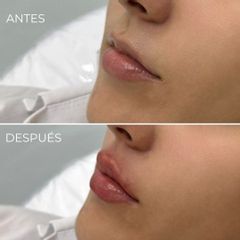 Aumento de labios - Dra. Daniella Tascon Barona