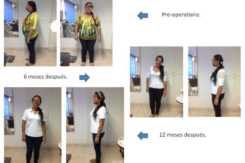 Tratamientos para adelgazar antes y después - 553848