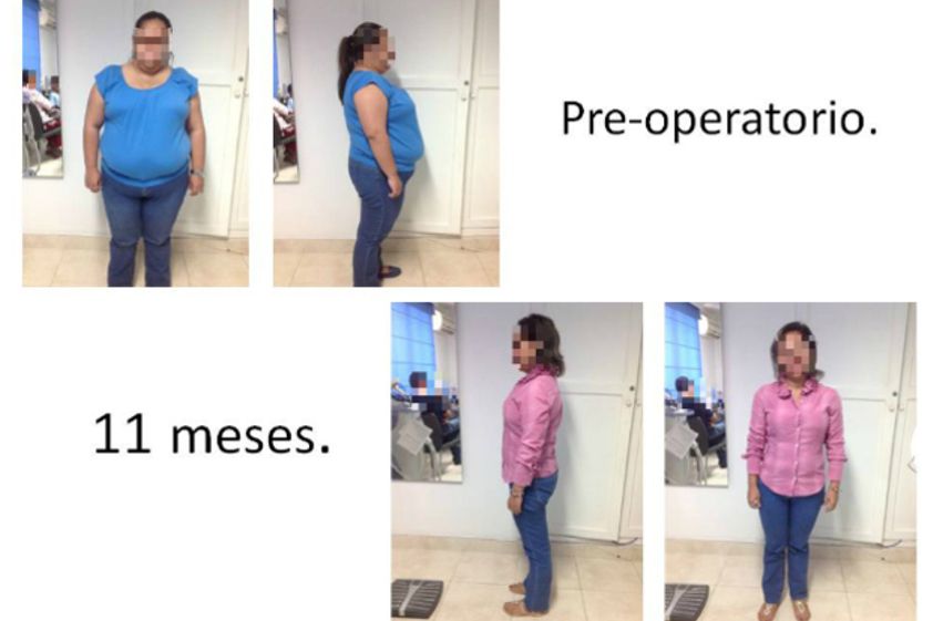 Tratamientos para adelgazar antes y después - 553863