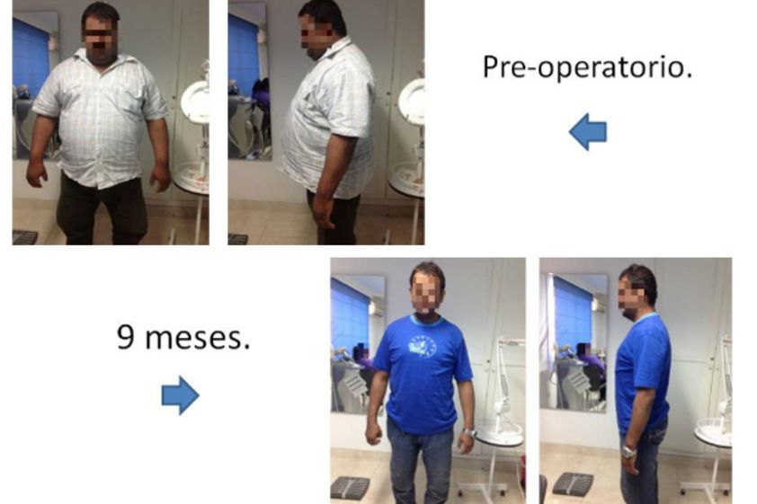 Balón Gástrico antes y después - 553869