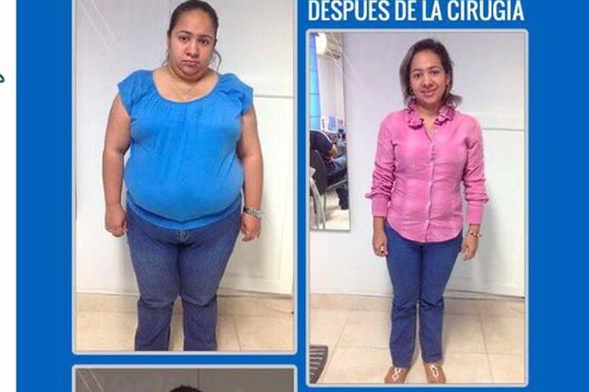 Manga Gástrica antes y después - 606908