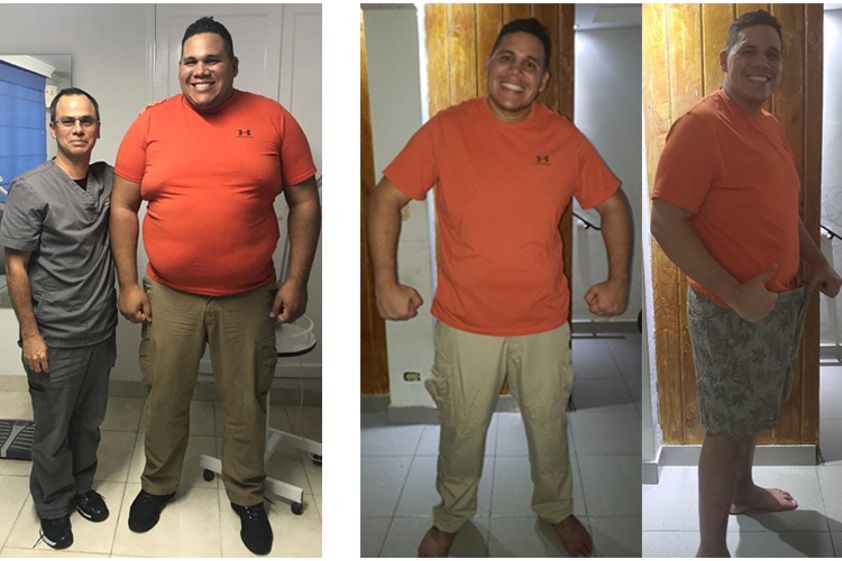 Manga Gástrica antes y después - 662810