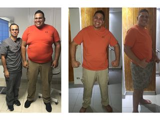 Cristian: 1 año, -44 kilos, manga gástrica - Dr. Diego Lozano