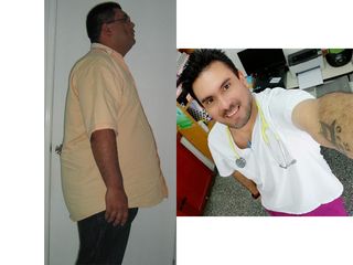 Manga gástrica, 11 años, -75 kilos - Dr. Diego Lozano