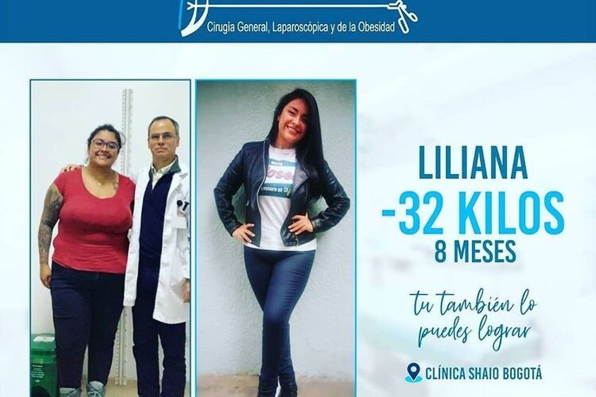 Bypass Gástrico antes y después - 792806