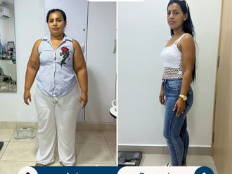 Manga Gástrica antes y después - 880431