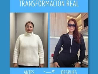 Balón Gástrico antes y después - 880434