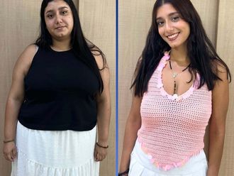 Manga Gástrica antes y después - 880435