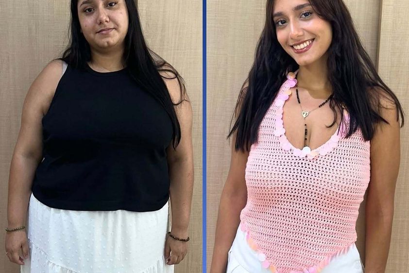 Manga Gástrica antes y después - 880435