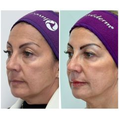 Rejuvenecimiento Facial - Dra. Catalina Uribe
