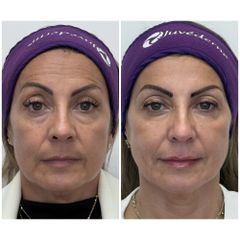 Rejuvenecimiento Facial - Dra. Catalina Uribe
