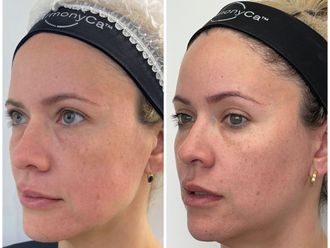 Rejuvenecimiento facial antes y después - 875124