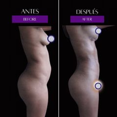 Lipoescultura - Dr Óscar Javier Rodríguez