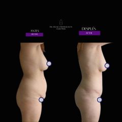 Abdominoplastia - Dr Óscar Javier Rodríguez