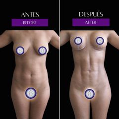Marcación Abdominal - Dr Óscar Javier Rodríguez