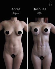 Marcación Abdominal - Dr Óscar Javier Rodríguez
