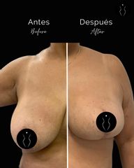 Mastopexia - Dr Óscar Javier Rodríguez