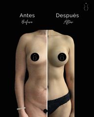 Abdominoplastia - Dr Óscar Javier Rodríguez