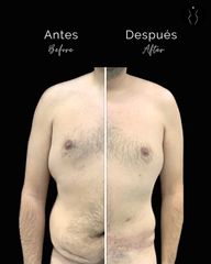 Abdominoplastia - Dr Óscar Javier Rodríguez