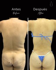 Abdominoplastia + lipoinyección - Dr Óscar Javier Rodríguez