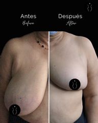 Mastopexia - Dr Óscar Javier Rodríguez