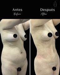 Marcación Abdominal - Dr Óscar Javier Rodríguez