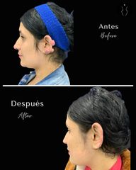 Cicatriz Queloide - Dr Óscar Javier Rodríguez