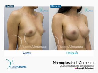 Antes y después Mamoplastia de Aumento