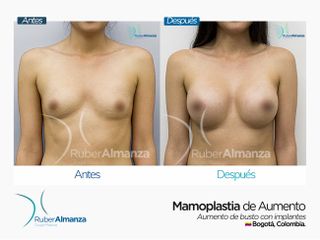 Antes y después Mamoplastia de Aumento 