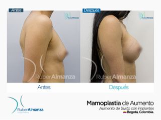 Antes y después Mamoplastia de aumento