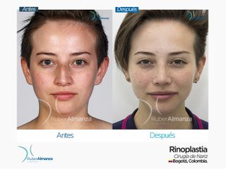 Rinoplastia Antes y después 