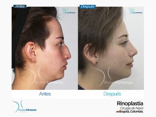 Rinoplastia Antes y después 