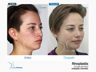 Rinoplastia antes y después 