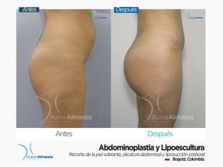Realce de Glúteos Antes y después