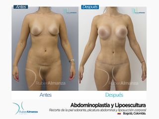 Abdominoplastia y Liposucción Antes y después 