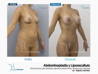 Abdominoplastia y Liposucción Antes y después 