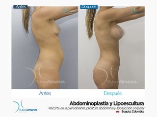 Abdominoplastia y Liposucción Antes y después 