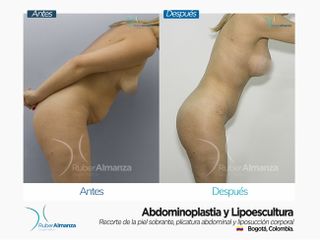 Abdominoplastia y Liposucción Antes y después 